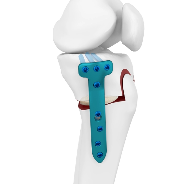 Pelat Pengunci Osteotomi Tibialis Medial Proksimal
