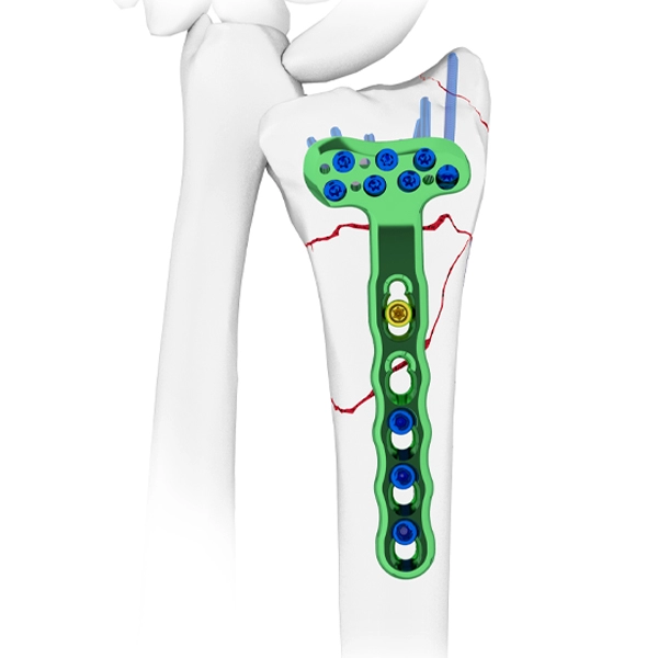 Pelat Pengunci Radial Volar Distal, Dengan Panduan Bor