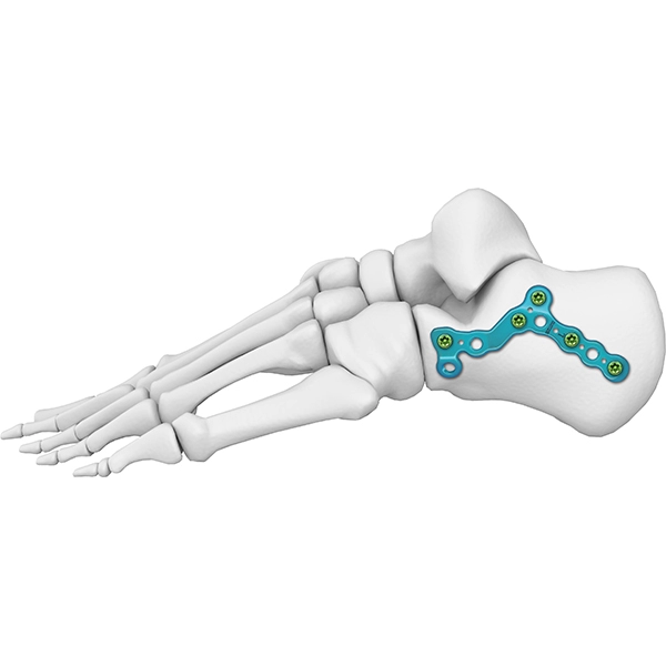 Plat Penguncian MT AP dan PT Calcaneal