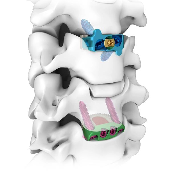 Pelat Penguncian Intervertebral Serviks Anterior Profil Nol dan Sistem Kombinasi Kandang